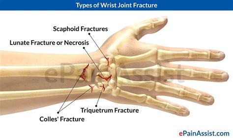 wrist fracture pain relief